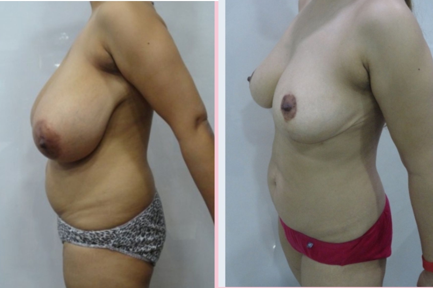 Breast Reduction